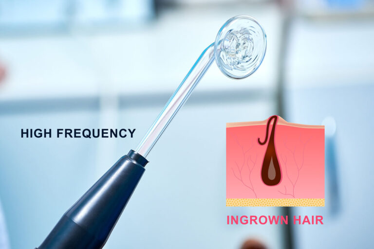 High Frequency For Ingrown Hairs